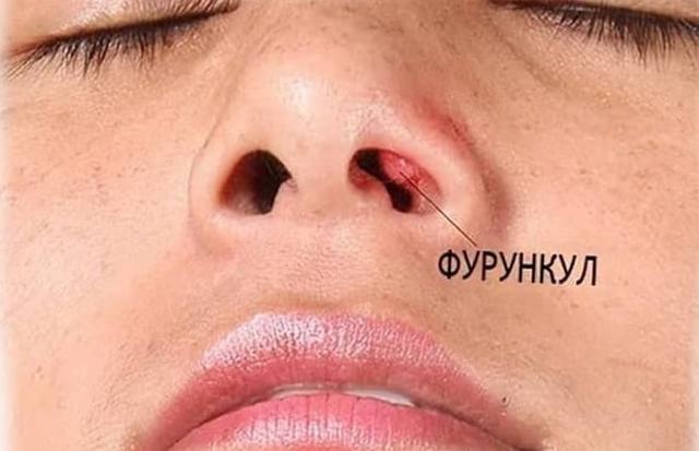 Как Выглядят Фурункулы Фото